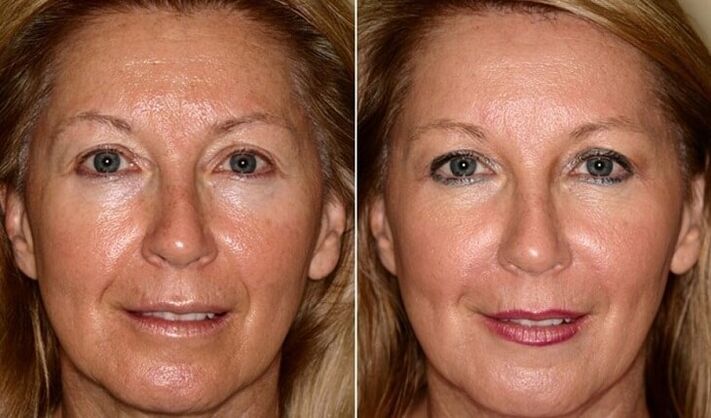 قبل و بعد از جوانسازی پوست صورت در خانه