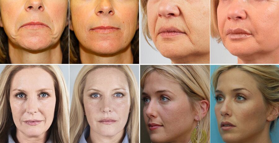 عکس زنان قبل و بعد از جوانسازی پوست صورت
